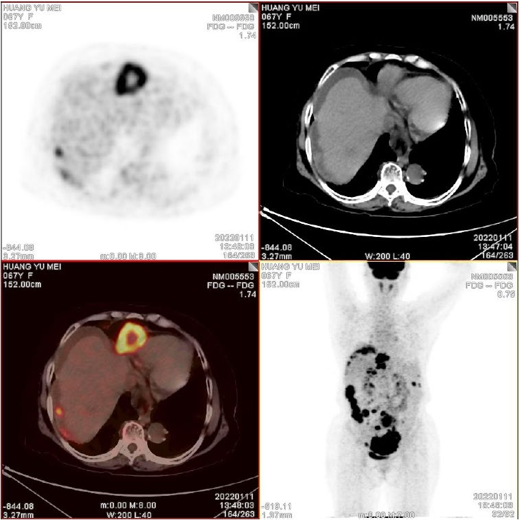 术前PET-CT (1).png